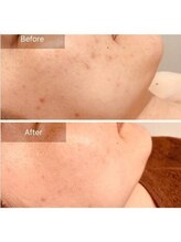 エミルカ 鹿児島店(EMILUCA)/ハーブピーリング