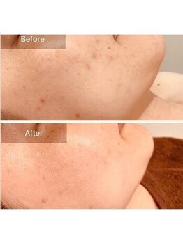 エミルカ 鹿児島店(EMILUCA)/ハーブピーリング