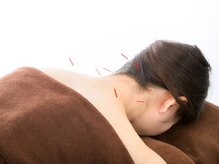 【全身鍼】肩こり・腰痛のお悩みを鍼で快適に！\6050→\3000