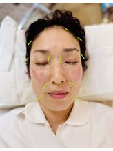 アノン 松山(Anon)/美容鍼でリフトアップ！