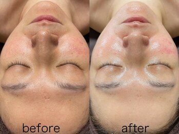 アトレ アンド ミューズ(Attrait×Muse)/『韓国肌管理』大人のピーリング