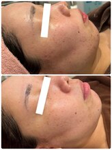 エステサロン ブレス 山形店(BLESS)/フェイシャル結果