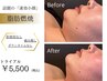 NEW★脂肪分解究極小顔コース【高濃度40％脂肪燃焼セラム使用】