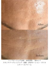 デコアイ(Deco eye)/40代男性　おでこのシワ