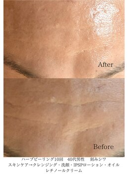 デコアイ(Deco eye)/40代男性 おでこのシワ