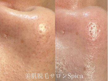 スピカ(SPICA)/毛穴洗浄+BBLでより綺麗に