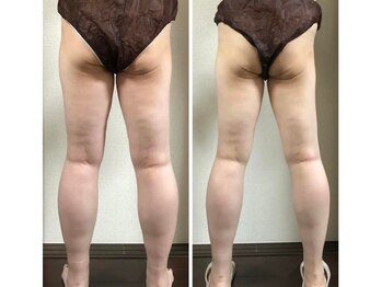 やまざき整体院/エステ機を使ってのダイエット