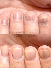 マリーロール 梅田店(Marie Laure)/自爪育成/深爪矯正/ネイルケア