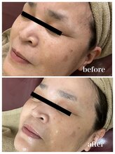 ジャスミン(Jasmin)/臍帯血幹細胞×NMN×AC-11