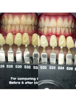 トウキョウスワーズ 池袋店(TOKYO SWRS)/#ホワイトニング #池袋 #渋谷