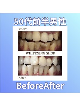 ホワイトニングショップ 西原店/50代前半男性☆BeforeAfter