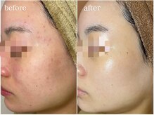 ミニョン(mignon)/ハーブピーリング