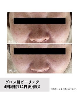 ティンク 心斎橋(Tink)/gross肌