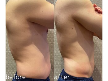 ビュウナ 銀座(BEAUNA)/メンズ【脂肪冷却&たるみ改善】