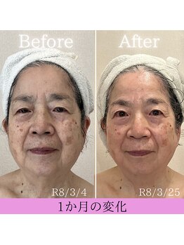 ココロ(COCORO)/エイジングケア 1か月の変化