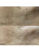 ジル(JilL)/水光ピールビフォーアフター
