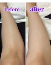 マルク(MARQUE)/セルフ脱毛でもこんなにツル肌!!