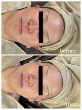 ジャスミン(Jasmin)/高濃度臍帯血幹細胞×NMN×AC-11