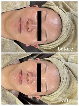 ジャスミン(Jasmin)/高濃度臍帯血幹細胞×NMN×AC-11