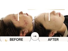 ハーゼ(Hase)/LDM/水玉トリプルリフティング