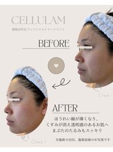 シェリア 桜新町/ほうれい線・たるみケア