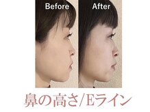 ラプリ 新宿店(Raplit)/隆鼻＋輪郭矯正40分10回