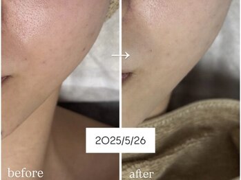 アンリミット 鹿児島天文館店(Une limit)/施術ビフォーアフター