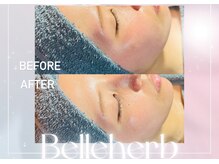 ベルハーブ(Belle herb)/30代/光フェイシャル/たるみハリ