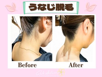 ヴィ シェーン(Vi Schoen)/うなじBefore/After 【W型】