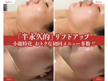 カシェボーテ(CACHE BEAUTE)の雰囲気（【半永久的小顔】キュッと引き締まったフェイスラインに★）