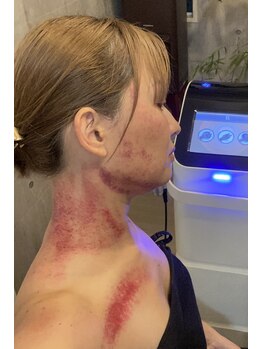 ビービー(BB)/ラジオ波＋バキューム