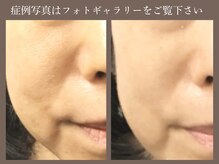 ラウン 京都(ROUN’)の雰囲気（【毛穴洗浄×ビタミン導入】頑固な角栓・シミやたるみの悩みに）