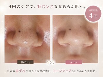 オレオマ(OLEOMA)の写真/デパコス使っても変わらなった毛穴ここまで変わる。