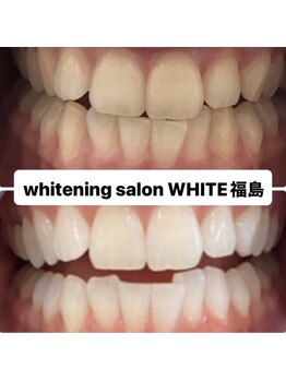 ホワイトニングサロン ホワイト(WHITE)/セルフホワイトニング効果