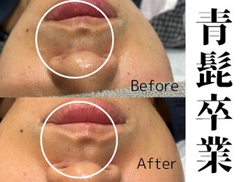 アメノチハレ(Ame/Hare)/自己処理が楽になる髭脱毛