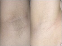 エピア 豊田店(Epia)/脇【シェービング付】