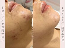 ファシネアオヤマ(FACINE AOYAMA)/トロイピール一回での変化！