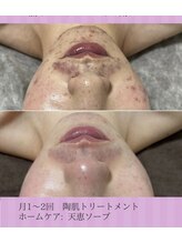 ホリホック/19歳男性　ニキビケア