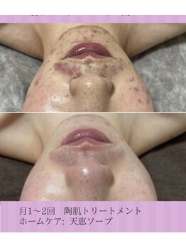 ホリホック/19歳男性　ニキビケア