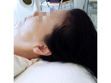 女性のための育毛促進・頭皮ケア専門サロン　イーズ／リバイタ　ららぽーと横浜/case2  60代女性　　after