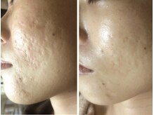 ノットノット 自由が丘(Not Knot)の雰囲気（ニキビケア・肌の凹凸ケア変化｜グリーンピール5days＋骨格矯正）