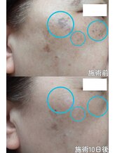 クレアナ ザ ビューティー(KULEANA the beauty)/光フォト