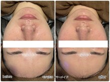 エンチャント(ENCHANT)/卵肌に★水素トリートメント