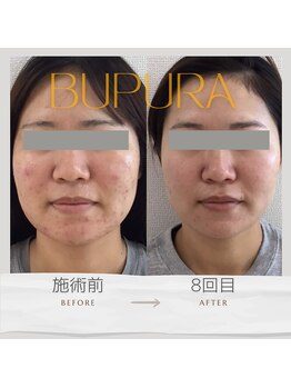 ブプラ 光の森店(BUPURA)/お客様ビフォーアフター