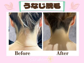 ヴィ シェーン(Vi Schoen)/うなじBefore/After 【W型】