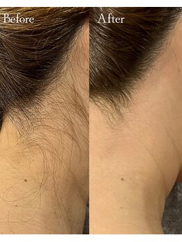 ロイヤルキューティー アンド 介正アップ美容整体院 博多店(ROYAL QT)/うなじ美人♪