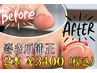 【新メニュー】フット巻爪補正　導入キャンペーン　2本 【両足】