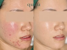 クク(ququ)の雰囲気（【繰り返す肌トラブル】剥離やダウンタイムなしでも効果を実感。）