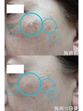 クレアナ ザ ビューティー(KULEANA the beauty)/光フォト