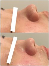 エステサロン ブレス 山形店(BLESS)/フェイシャル結果